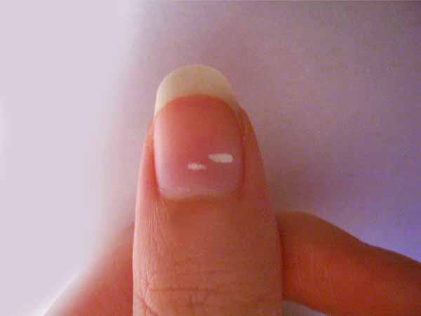 White Spots on Nails: What They Really Are and When to Worry